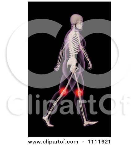 Clipart 3d Xray Of A Walking Overweight Woman With Knee Pain - Royalty Free CGI Illustration by KJ Pargeter