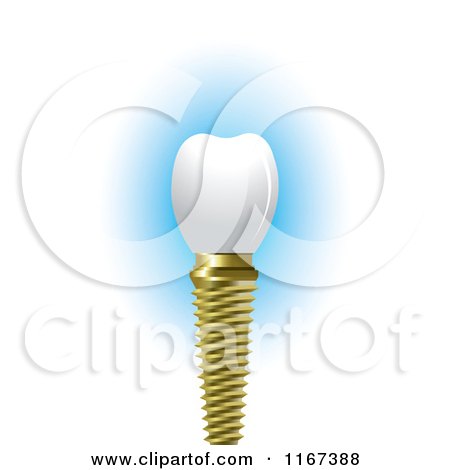 Clipart of a Dental Tooth Implant - Royalty Free Vector Illustration by Lal Perera