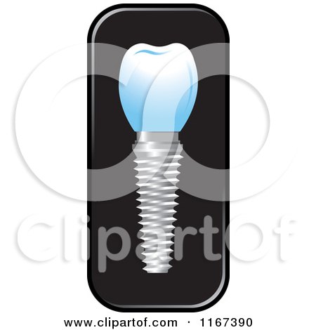 Clipart of a Dental Tooth Implant 3 - Royalty Free Vector Illustration by Lal Perera