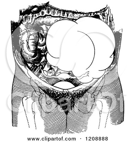 Clipart of a Vintage Black and White Ovarian Tumor on the Left Side of the Pelvis - Royalty Free Vector Illustration by Prawny Vintage