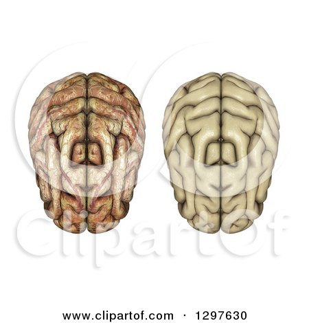 Clipart of a 3d Aerial View of Healthy and Diseased Human Brains, on White - Royalty Free Illustration by KJ Pargeter