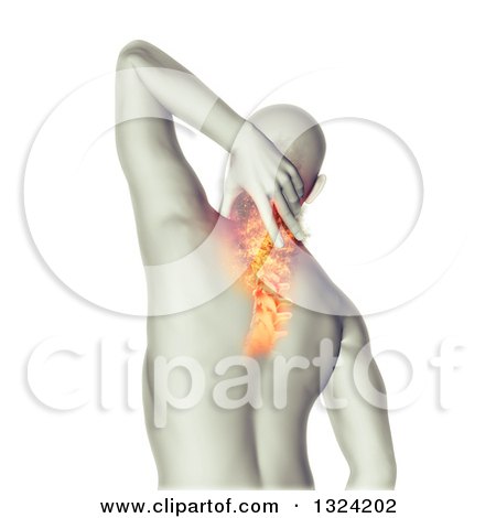 Clipart of a 3d Rear View of a Medical Anatomical Male Reaching Back, with Visible Flaming Neck Vertebrae Pain on White - Royalty Free Illustration by KJ Pargeter