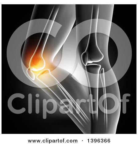 Clipart of a 3d Xray of Woman's Glowing Knee Pain on Gray - Royalty Free Illustration by KJ Pargeter