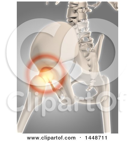 Clipart of a 3d Human Skeleton of a Hip with Glowing Pain, on a Gray Background - Royalty Free Illustration by KJ Pargeter