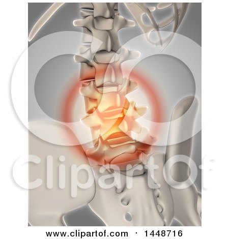 Clipart of a 3d Human Skeleton Glowing Spinal Pain, on a Gray Background - Royalty Free Illustration by KJ Pargeter