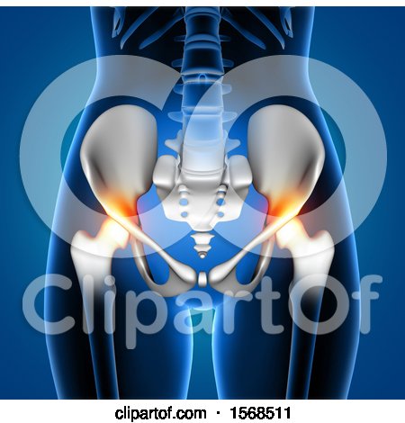 Clipart of a 3d Woman with Red Highlighted Hip Pain, on a Blue Background - Royalty Free Illustration by KJ Pargeter