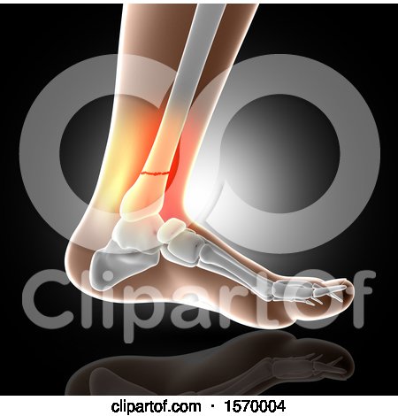 Clipart of a 3d Closeup of a Human Foot with Glowing Broken Ankle, on Gray - Royalty Free Illustration by KJ Pargeter