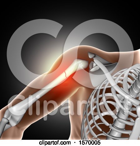 Clipart of a 3d Xray with Glowing Broken Shoulder Bone on Gray - Royalty Free Illustration by KJ Pargeter
