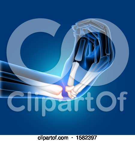Clipart of a 3d Xray of a Bent Wrist - Royalty Free Illustration by KJ Pargeter
