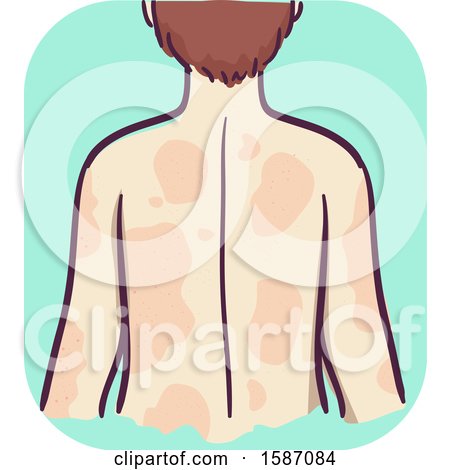 Clipart of a Man Showing His Back and Breaking out in Hives - Royalty Free Vector Illustration by BNP Design Studio