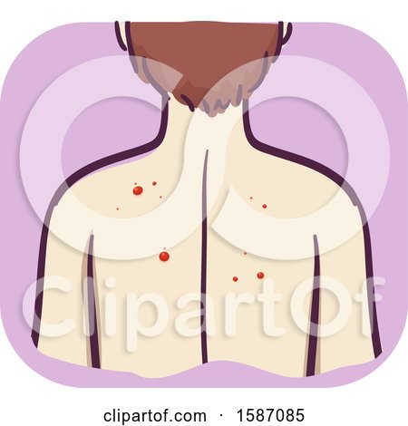 Clipart of a Man with Red Mole or Papule Growth on His Back - Royalty Free Vector Illustration by BNP Design Studio