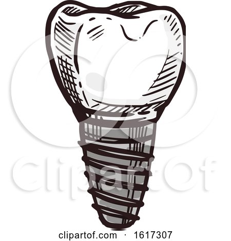 Tooth Implant by Vector Tradition SM