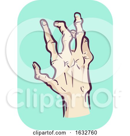 Hands Symptom Joint Deformity Illustration by BNP Design Studio