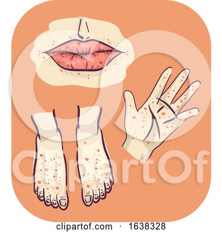 Symptoms Hand Feet Mouth Rashes Illustration by BNP Design Studio