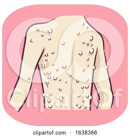 Back Symptom Bumps on Skin Illustration by BNP Design Studio
