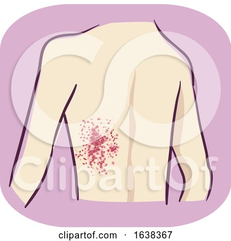 Back Symptom Purpura Illustration by BNP Design Studio