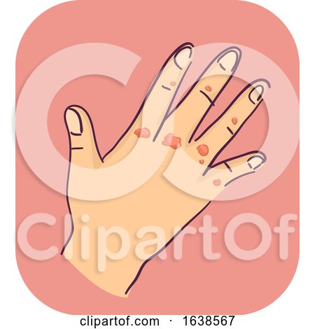 Hand Symptoms Scarred Illustration by BNP Design Studio