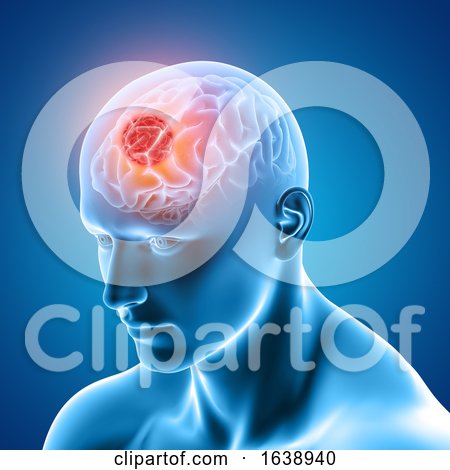 3D Medical Image Showing Male Figure with Brain Tumour by KJ Pargeter