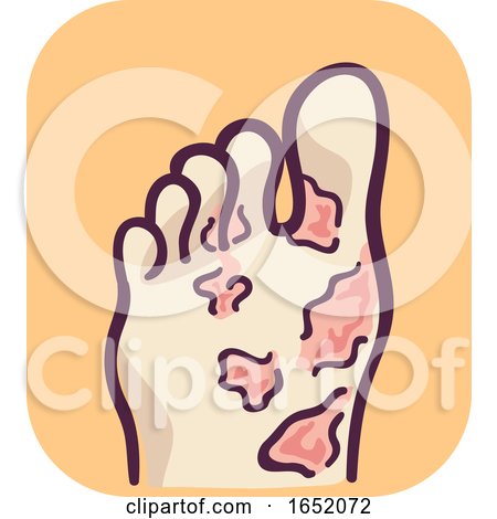 Foot Blisters Illustration by BNP Design Studio
