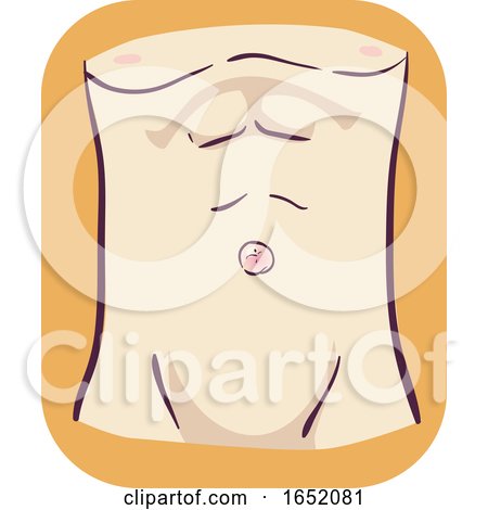 Symptom Umbilical Hernia Illustration by BNP Design Studio