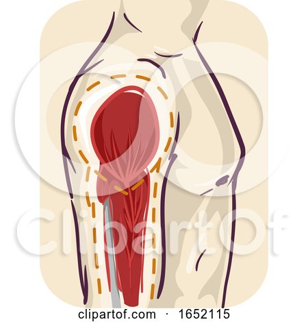 Man Muscle Atrophy Illustration by BNP Design Studio