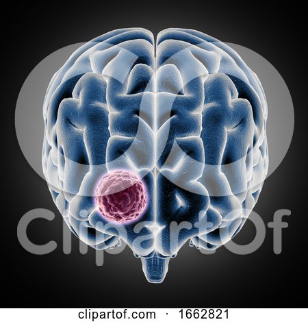 3D Medical Image Showing Brain with Tumor Growing by KJ Pargeter