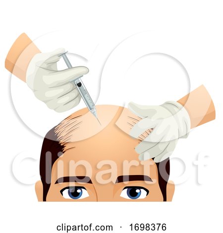 Man Head Hair Injection Illustration by BNP Design Studio