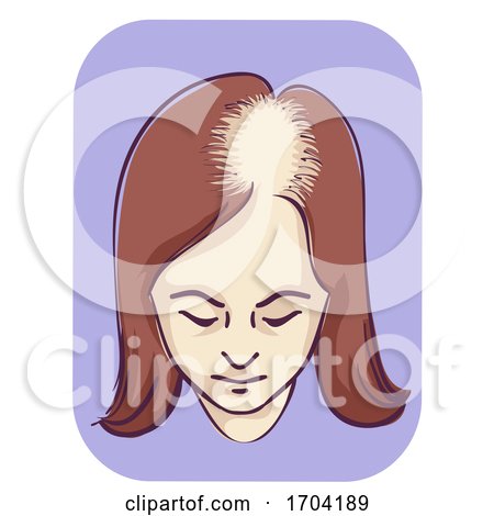 Girl Female Pattern Baldness Frontal Scalp by BNP Design Studio