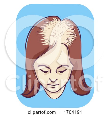 Girl Female Pattern Baldness Top Area Illustration by BNP Design Studio