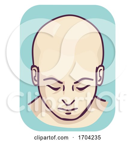 Man Bald Full Head Hair Loss Illustration by BNP Design Studio