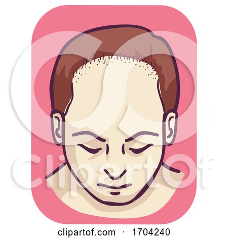 Male Pattern Baldness Frontal Hair Loss by BNP Design Studio