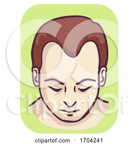 Man Pattern Baldness Hairline Loss Illustration by BNP Design Studio