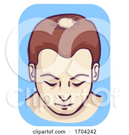 Man Pattern Baldness Hair Loss Vertex Illustration by BNP Design Studio