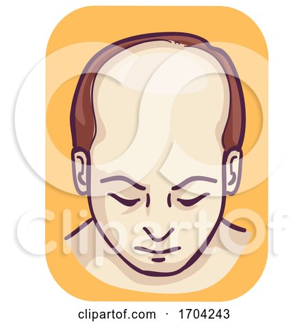 Man Pattern Baldness Top Hair Loss Illustration by BNP Design Studio