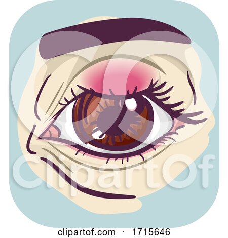 Symptom Eyes Chalazion Illustration by BNP Design Studio