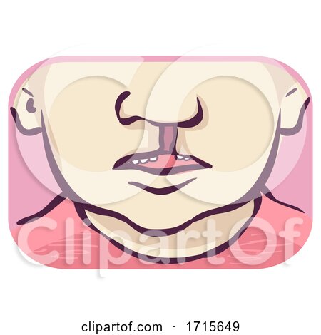 Symptom Cleft Palate Unilateral Illustration by BNP Design Studio