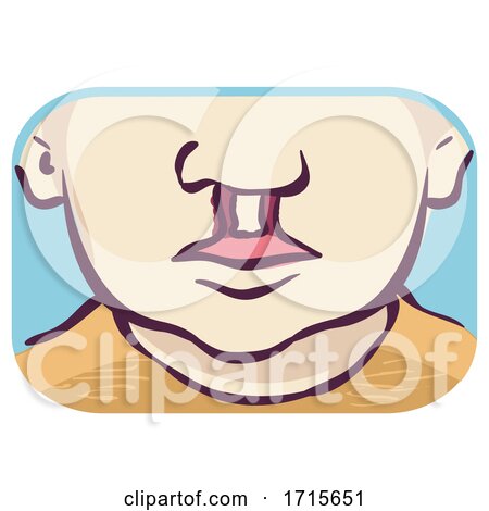 Symptom Cleft Lip Palate Bilateral Illustration by BNP Design Studio