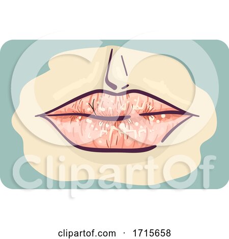 Symptom Dry Chapped Lips Illustration by BNP Design Studio
