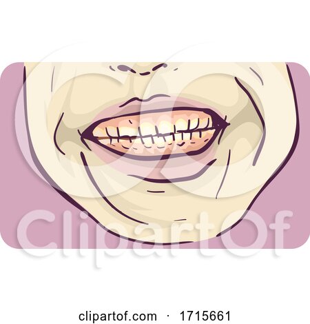 Symptom Teeth Grinding Illustration by BNP Design Studio