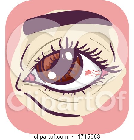 Symptom Red Spot on Eye Illustration by BNP Design Studio