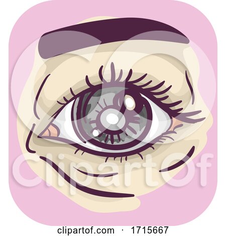 Symptoms Hazy Pupil Glaucoma Illustration by BNP Design Studio