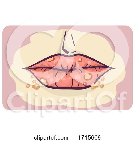 Symptoms Lip Cold Sore Illustration by BNP Design Studio