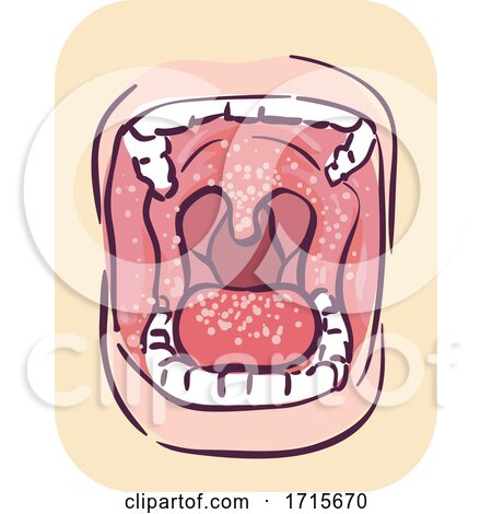 Symptoms Oral Thrush Illustration by BNP Design Studio