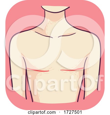 Breast Surgery Mastectomy Illustration by BNP Design Studio