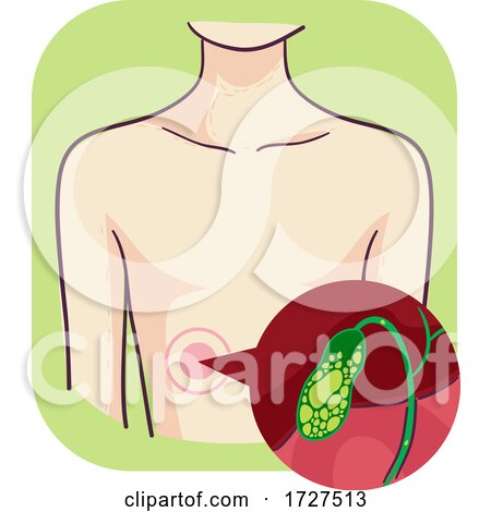 Symptoms Gallbladder Gallstones Illustration by BNP Design Studio