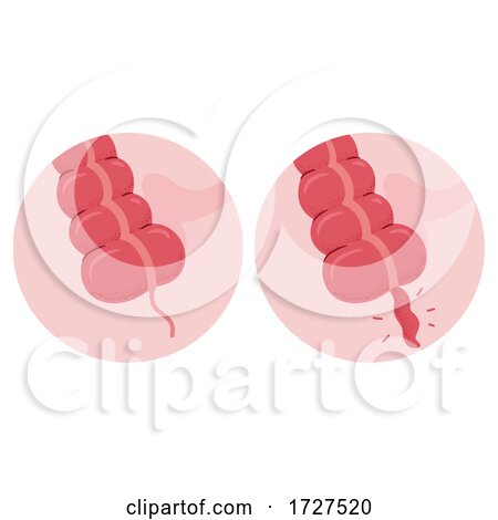 Appendicitis Appendix Inflammation Illustration by BNP Design Studio