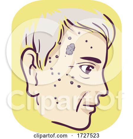 Man Symptom Black Spots Illustration by BNP Design Studio