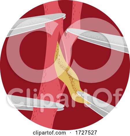 Carotid Artery Surgery Illustration by BNP Design Studio