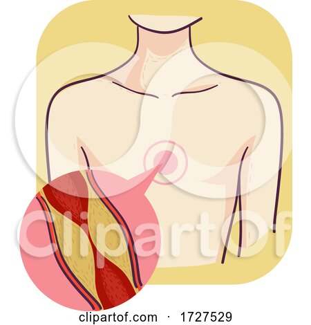 Heart Coronary Artery Bypass Plaque Illustration by BNP Design Studio