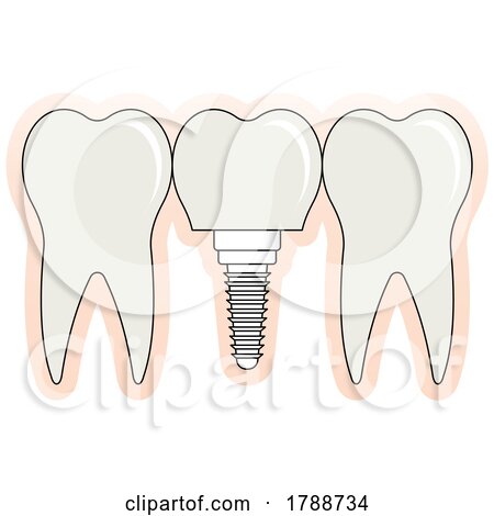 Tooth Implant by Lal Perera